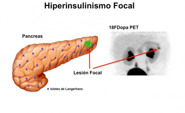 Sintomas del hiperinsulinismo